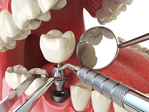 Best Emergency Tooth Extraction in Walnut, IL